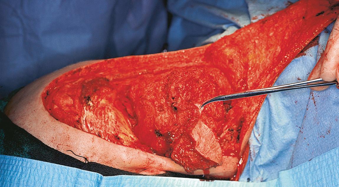 Figure 15.50, The attachments of the suboccipital muscles are detached from the lower border of the occipital bone.