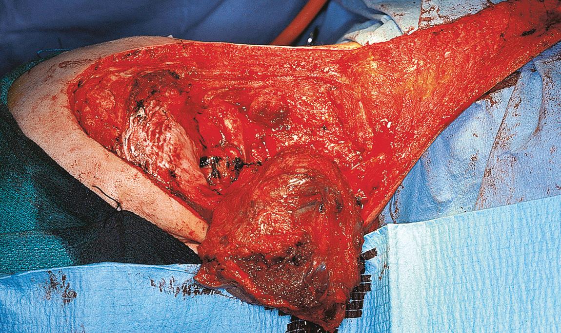 Figure 15.51, The mobilized tumor is reflected laterally by meticulous dissection on the posterior laminae, carefully protecting the vertebral artery.