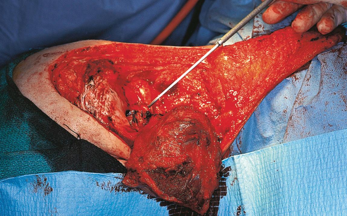 Figure 15.52, The tortuous part of the vertebral artery is dissected off the tumor.