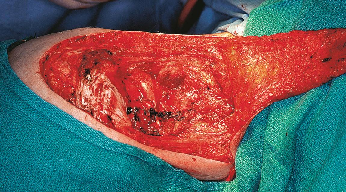 Figure 15.53, The surgical field after excision of the tumor.