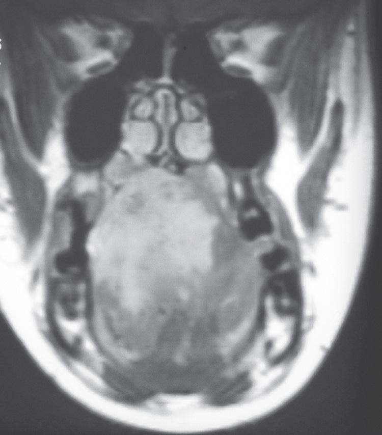 Figure 15.8, A coronal view of the T1-weighted postcontrast magnetic resonance imaging scan of the same patient depicted in Fig. 15.5 showing the hemangioma extending beyond the midline.