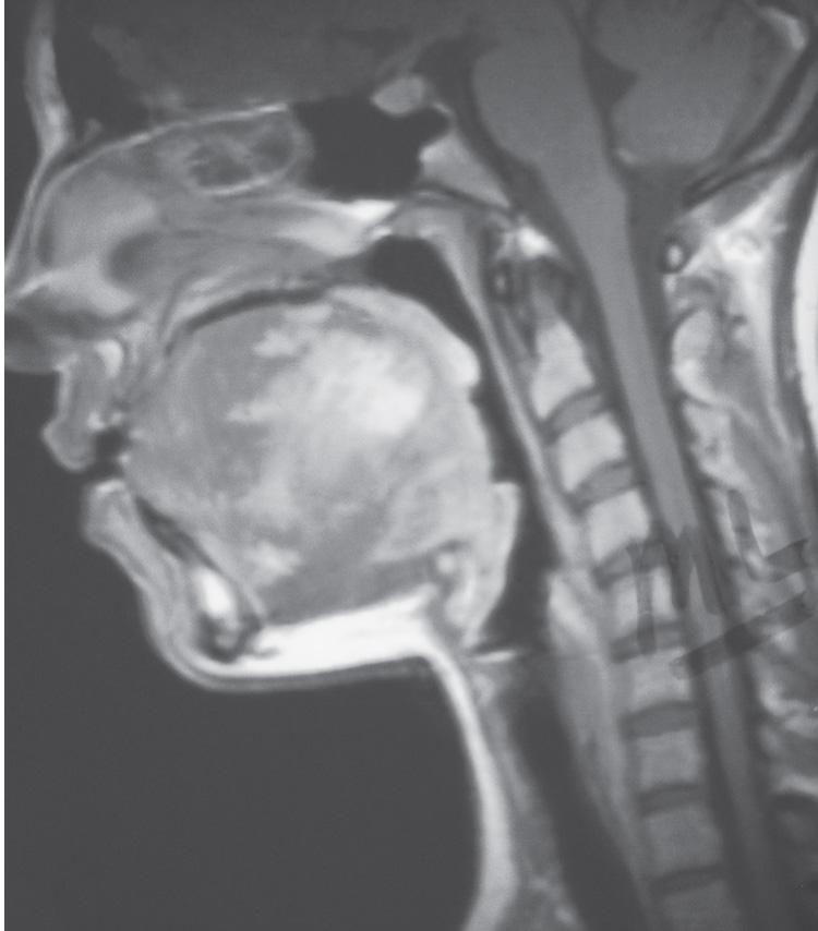 Figure 15.9, A sagittal view of a T1-weighted postcontrast magnetic resonance imaging scan of the patient seen in Figs. 15.7 and 15.8 with a hemangioma of the tongue.