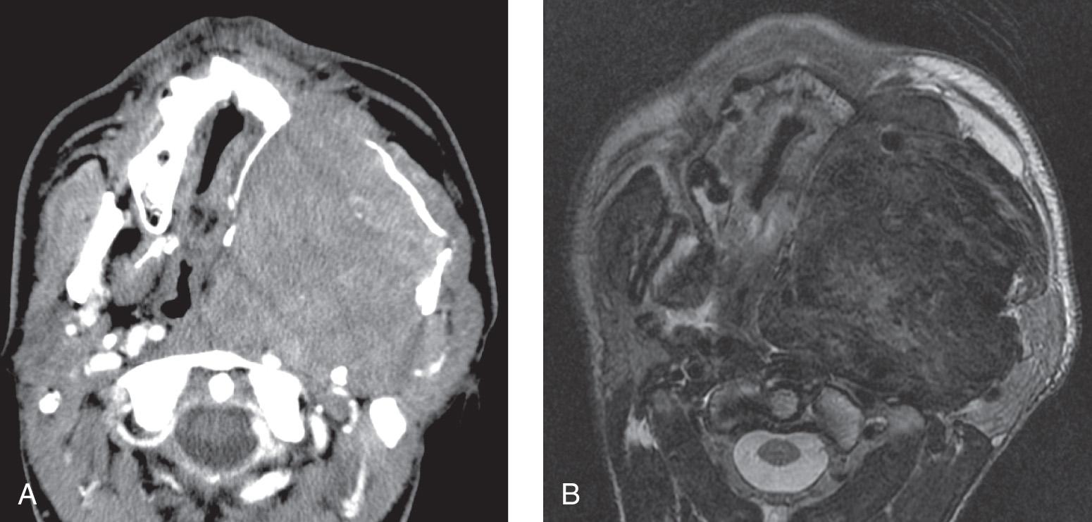 Figure 15.11, A , A contrast-enhanced computed tomography scan in the axial view showing a large tumor that has regressively remodeled the left maxillary bony walls and pterygoid plates. B , Corresponding axial T2-weighted magnetic resonance imaging clearly shows the encapsulated, pushing tumor in relation to the left upper alveolus, soft tissues and fat of the cheek, the prevertebral fascia, the deep aspect of the left parotid gland, and the retromandibular vein.