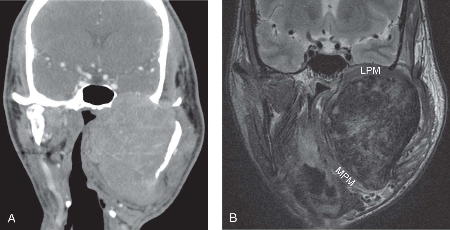 Figure 15.12, A , A contrast-enhanced computed tomography scan of the neck in the coronal view demonstrates wide attenuation of the bony skull base, but there is a clear demarcation at the superior interface of the tumor with the dura and brain without signs of invasion. B , Corresponding T2-weighted magnetic resonance imaging in the coronal view shows that the tumor is separated from the bony skull base by the superiorly displaced left lateral pterygoid muscle ( LPM ). The medial pterygoid muscle ( MPM ) is draped over the medial aspect of the tumor between the pterygoid plates and the mandible.