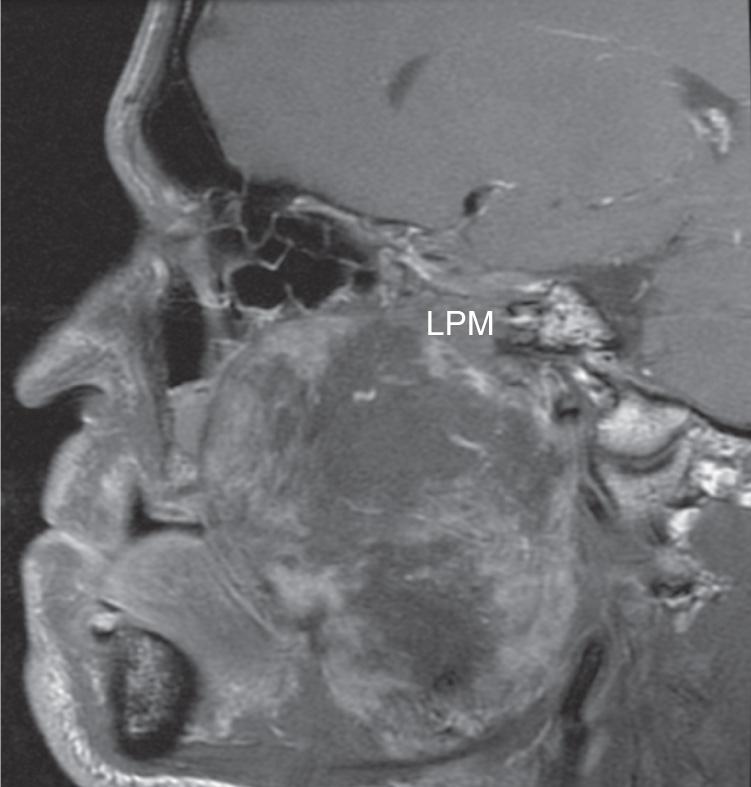 Figure 15.13, Sagittal view of postcontrast T1-weighted magnetic resonance imaging shows the heterogeneously enhancing tumor with the lateral pterygoid muscle ( LPM ) separating it from the skull base.