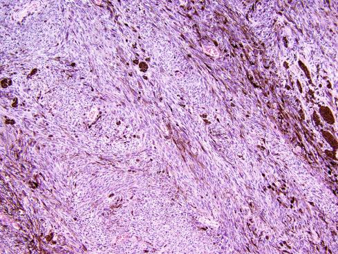 Fig. 29.1, Melanotic schwannoma, consisting of a heavily pigmented, fascicular proliferation of relatively uniform spindled cells.