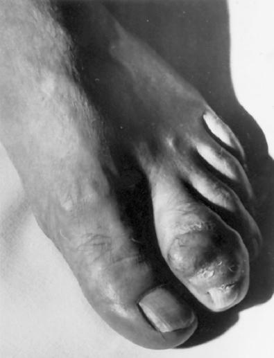 Fig. 29.11, Clear cell sarcoma of the second toe.