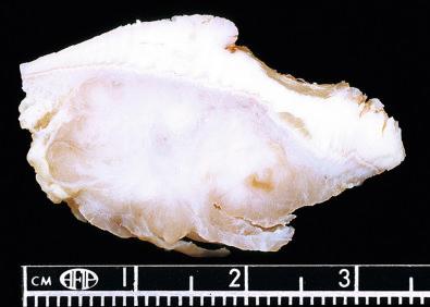 Fig. 29.12, Clear cell sarcoma diffusely infiltrating tendon ( top ) and skeletal muscle ( bottom ).