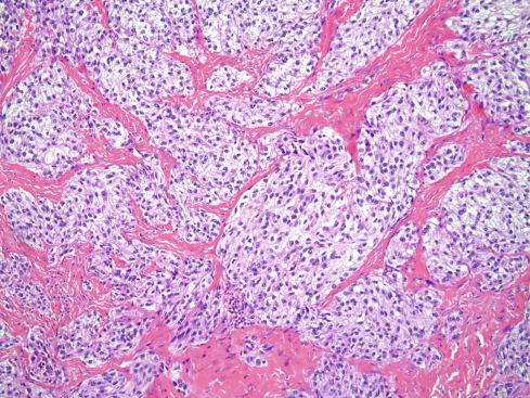 Fig. 29.14, Fibrous tissue septa divide clear cell sarcoma into well-defined nests and groups of pale-staining tumor cells.