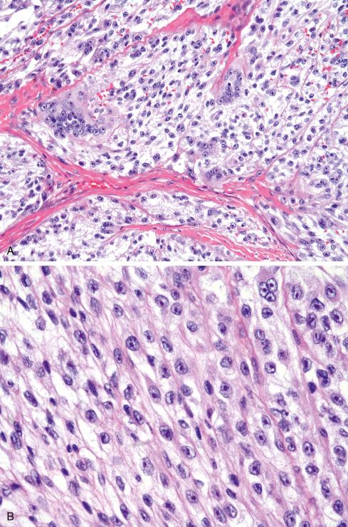 Fig. 29.16, A, Clear cell sarcoma showing spindled cells with strikingly clear cytoplasm and tumor giant cells with peripherally placed nuclei of uniform size and shape. B and C, Cells can appear spindled ( B ) when cut longitudinally or epithelioid ( C ) when cut transversely. Note prominent melanoma-like nucleoli.