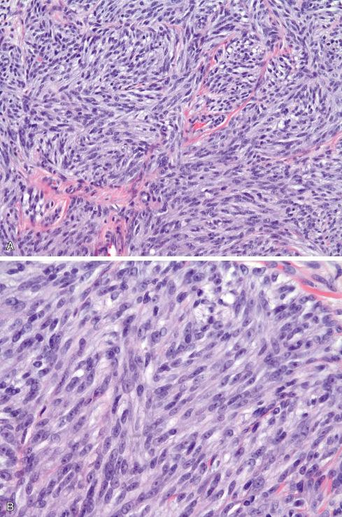 Fig. 29.17, A and B, Clear cell sarcoma with more fascicular growth and basophilic cytoplasm.