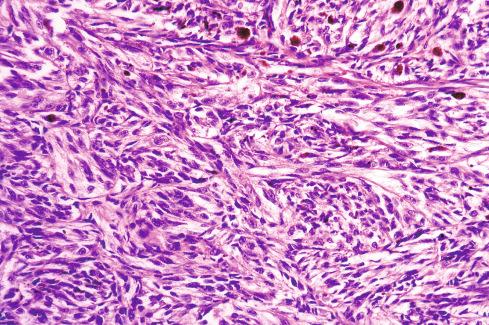 Fig. 29.18, Clear cell sarcoma with perceptible melanin pigment.