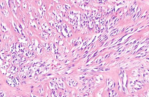 Fig. 29.19, Clear cell sarcoma with hyalinization.