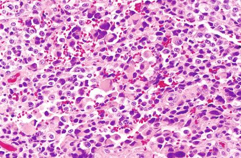 Fig. 29.20, Metastatic clear cell sarcoma with marked pleomorphism and essentially no spindling. Metastatic deposits of this type resemble carcinoma or melanoma.