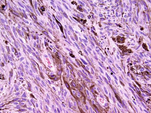 Fig. 29.2, Higher-power view of melanotic schwannoma, showing a fascicular proliferation of uniform, generally bland schwannian-appearing spindled cells with abundant melanin pigment and occasional intranuclear pseudoinclusions.