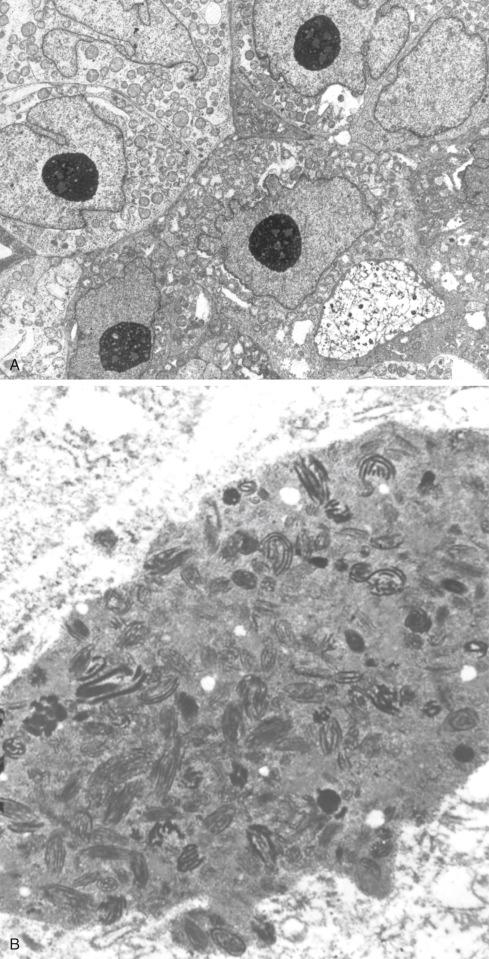 Fig. 29.22, Electron Micrographs of Clear Cell Sarcoma.