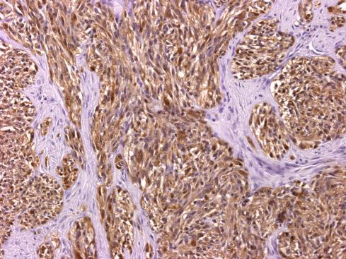 Fig. 29.21, Clear cell sarcoma with S-100 protein expression.