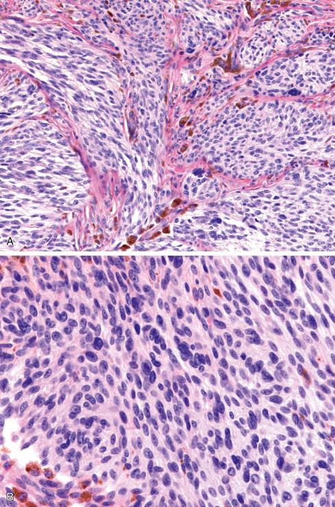 Fig. 29.23, Cellular blue nevus showing partitioning of tumor by fibrous bands and prominent pigmentation (A) but cells with less atypia and less prominent nucleoli (B) than clear cell sarcoma.