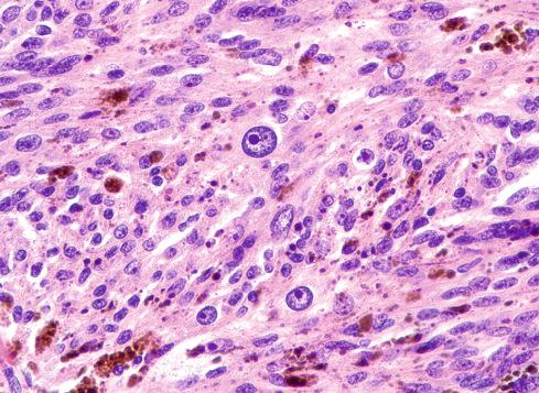 Fig. 29.4, Melanotic schwannomas with marked nucleomegaly and prominent melanoma-like nucleoli.