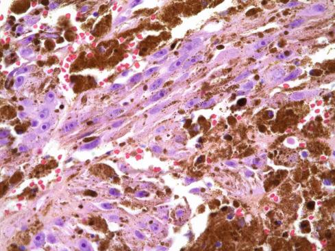 Fig. 29.5, Densely pigmented melanotic schwannoma with cytologically malignant cells. Heavily pigmented lesions may be difficult to evaluate cytologically.