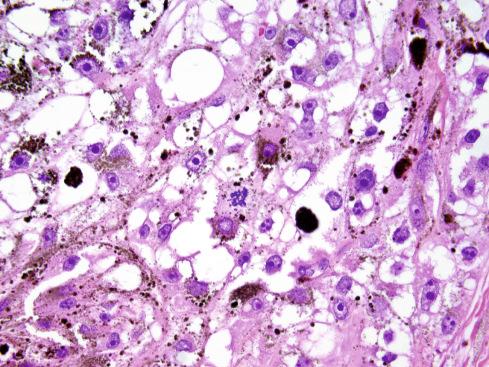 Fig. 29.6, Melanotic schwannoma with atypical mitotic figure ( center ). The presence of elevated mitotic activity (>2 figures/10 hpf) has been associated with adverse outcome.