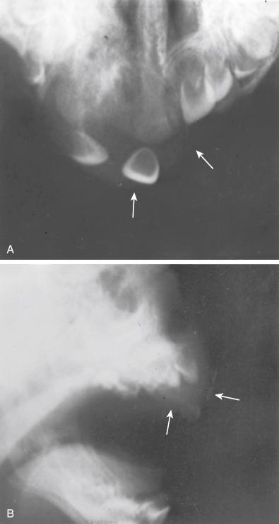 Fig. 29.8, Radiographs of pigmented neuroectodermal tumor of infancy (retinal anlage tumor) in the maxilla. Tumor is a vaguely outlined soft tissue mass ( arrows ) with destruction of the maxilla (A) and displacement of teeth (B) .