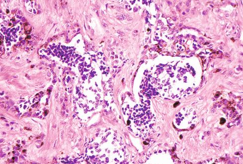 Fig. 29.9, Melanotic neuroectodermal tumor of infancy, composed of irregular glandlike spaces lined by pigmented epithelial cells and containing detached clusters of primitive neuroepithelium.