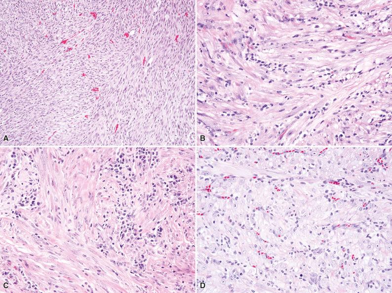 Figure 10.1, Inflammatory Myofibroblastic Tumor.