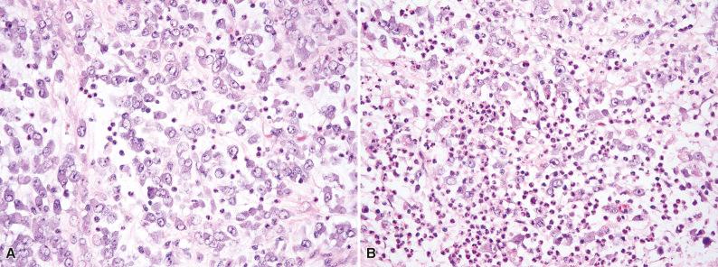 Figure 10.3, Epithelioid Inflammatory Myofibroblastic Sarcoma.