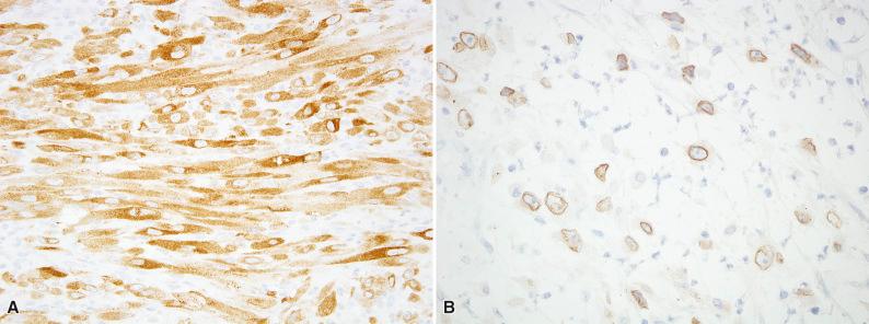 Figure 10.4, ALK Expression in Inflammatory Myofibroblastic Tumor.