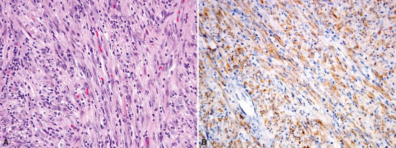 Figure 10.5, Inflammatory Myofibroblastic Tumor With ROS1 Rearrangement.