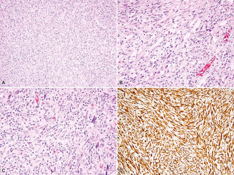 Figure 10.6, Inflammatory Leiomyosarcoma.