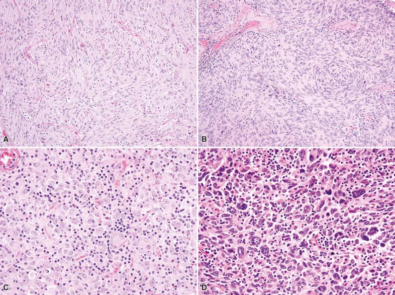 Figure 10.7, Follicular Dendritic Cell Sarcoma.