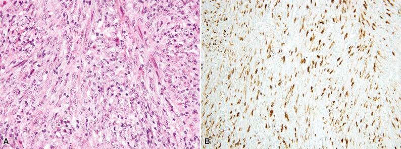 Figure 10.8, Inflammatory Pseudotumor-Like Follicular Dendritic Cell Sarcoma.