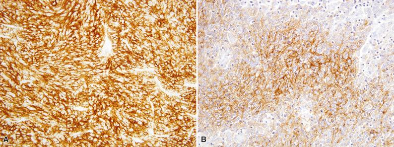 Figure 10.9, Follicular Dendritic Cell Sarcoma.