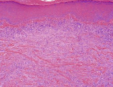 FIGURE 13-11, Dermatomyofibroma. Bland myofibroblasts arranged in fascicles, which run parallel to the overlying epidermis.