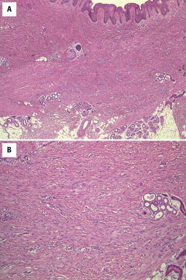 FIGURE 13-12, Fibroblastic connective tissue nevus. A, Dermal-based proliferation of bland fibroblasts with overlying epidermal papillary hyperplasia. B, The cells arranged in haphazard fascicles, which entrap cutaneous appendages and may extend into subcutis.