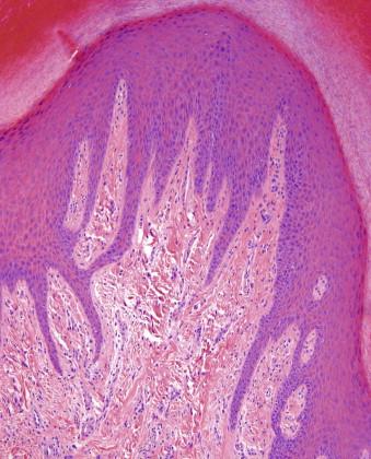 FIGURE 13-17, Acral fibrokeratoma. Acanthotic epidermis surrounds vertically oriented spindle cells in the collagenous stroma.