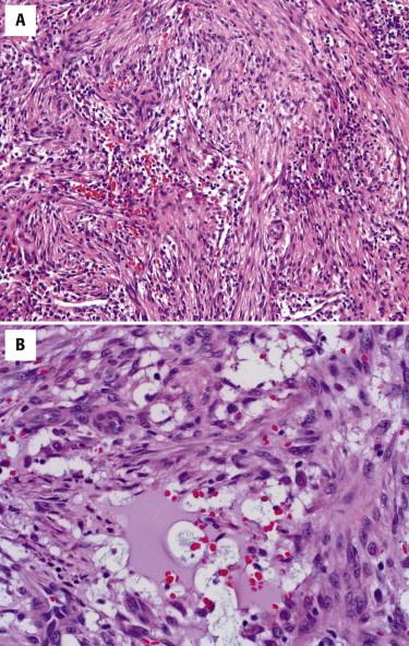 FIGURE 13-18, Nodular fasciitis. A, Loose proliferation of bland myofibroblasts in a tissue culture-like growth pattern admixed with reactive vessels, extravasated red blood cells, and chronic inflammatory cells. B, High-power view showing plump myofibroblasts with oval nuclei, fine chromatin, and small nucleoli. The cells surround a cystic area in nodular fasciitis.