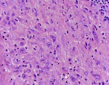 FIGURE 13-19, Proliferative fasciitis. A variant of fasciitis with predominance of large, ganglion-like myofibroblasts.