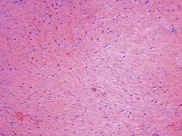 FIGURE 13-20, Fibroma of tendon sheath. Hypocellular lesion composed of bland myofibroblasts dispersed in a densely collagenous stroma.