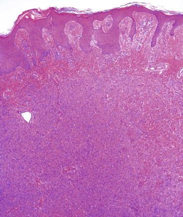 FIGURE 13-2, Dermatofibroma. Circumscribed dermal spindle cell tumor. The epidermis over the dermatofibroma often shows hyperplasia and basilar hyperpigmentation.