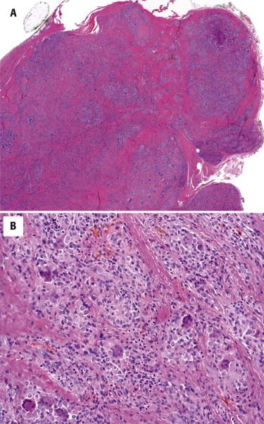 FIGURE 13-21, Tenosynovial giant cell tumor. A, Low power view showing a well-circumscribed, nodular mass. B, Components of a tenosynovial giant cell tumor: round to oval mononuclear epithelioid cells, osteoclast-type giant cells, lymphocytes, and hemosiderin deposits. Foamy histiocytes are often present (not shown).