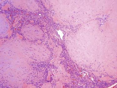 FIGURE 13-22, Myofibroma. Biphasic tumor composed of basophilic myoid nodules surrounded by immature mesenchymal cells and hemangiopericytoma-like vascular spaces.