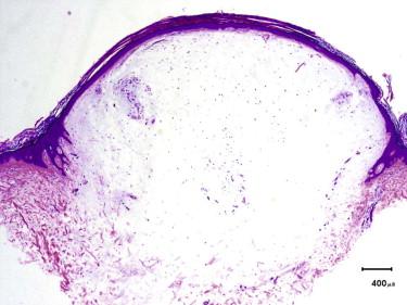 FIGURE 13-23, Myxoma. A small paucicellular circumscribed myxoid nodule is seen in the dermis.