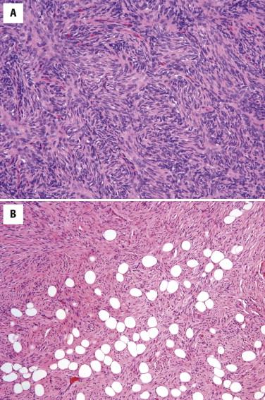 FIGURE 13-30, Dermatofibrosarcoma protuberans. A, Storiform growth pattern of uniform, slender spindled cells with little nuclear atypia. B, Infiltration into the subcutis resulting in entrapment of individual fat cells is typical.