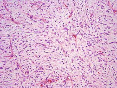 FIGURE 13-32, Myxoid dermatofibrosarcoma protuberans. Widely spaced, stellate tumor cells loosely distributed in a myxoid stroma.