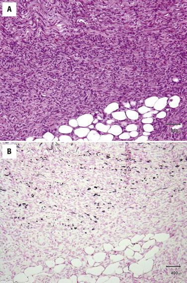 FIGURE 13-33, Bednar tumor (pigmented dermatofibrosarcoma protuberans [DFSP]). A, DFSP with scattered pigmented cells. B, A Fontana stain confirms the presence of melanin pigment.