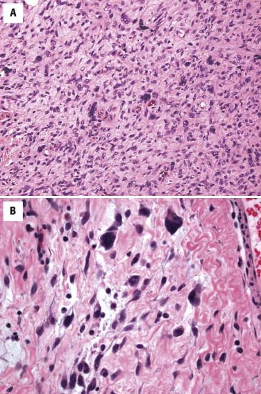 FIGURE 13-34, Giant cell fibroblastoma. A, Giant cell fibroblastoma is composed of spindled to stellate tumor cells punctuated by multinucleated tumor cells in a myxoid to hyalinized background. B, The multinucleated cells frequently line pseudovascular spaces.