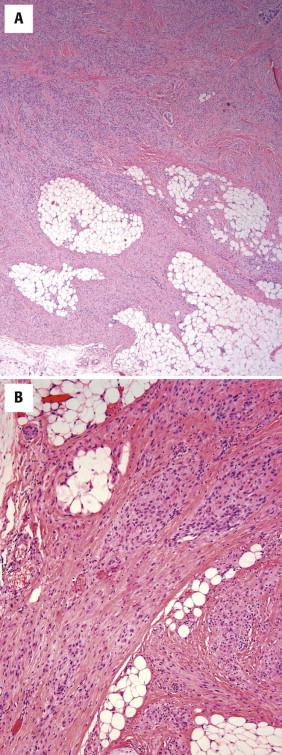 FIGURE 13-35, Plexiform fibrohistiocytic tumor (PFHT). A, PFHT has an infiltrative, plexiform growth pattern composed of discrete nodules of histiocytic cells connected by fascicles of myofibroblastic cells. B, The nodules are composed of round to slightly spindled histiocytic cells and may contain multinucleated giant cells. The myofibroblastic component is reminiscent of fibromatosis.